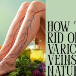 How to Get Rid of Varicose Veins Naturally?