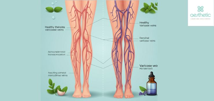 How to Get Rid of Varicose Veins Naturally?