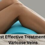 Varicose Veins