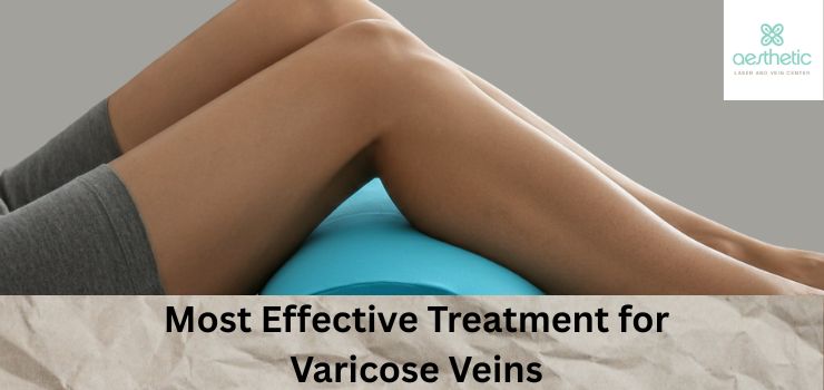 Varicose Veins