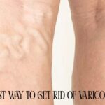 Varicose veins