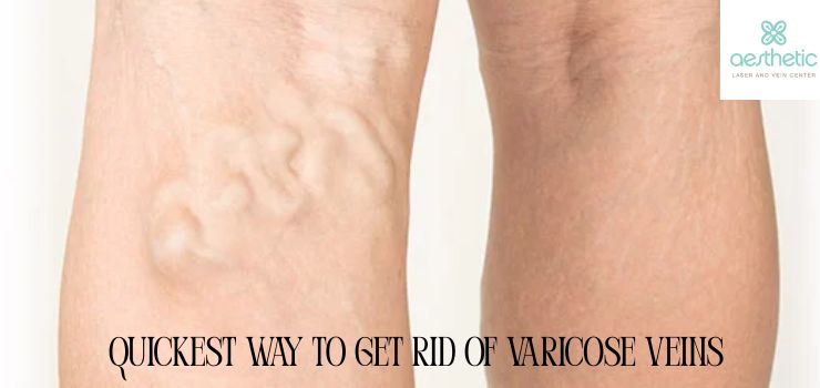 Varicose veins