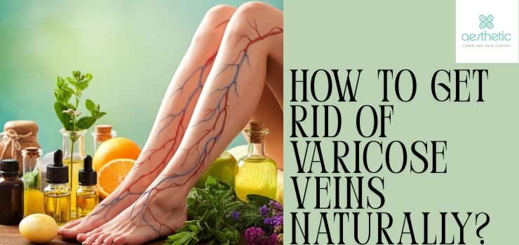 How to Get Rid of Varicose Veins Naturally?