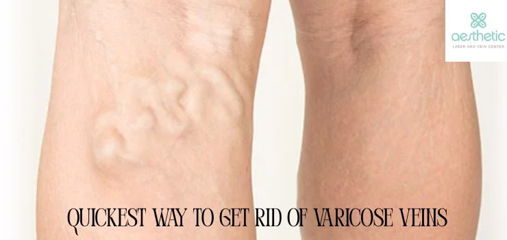 Varicose veins